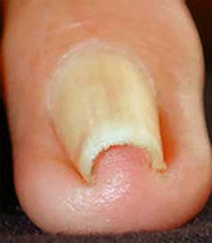 Ingrown Toe Nail Surgery